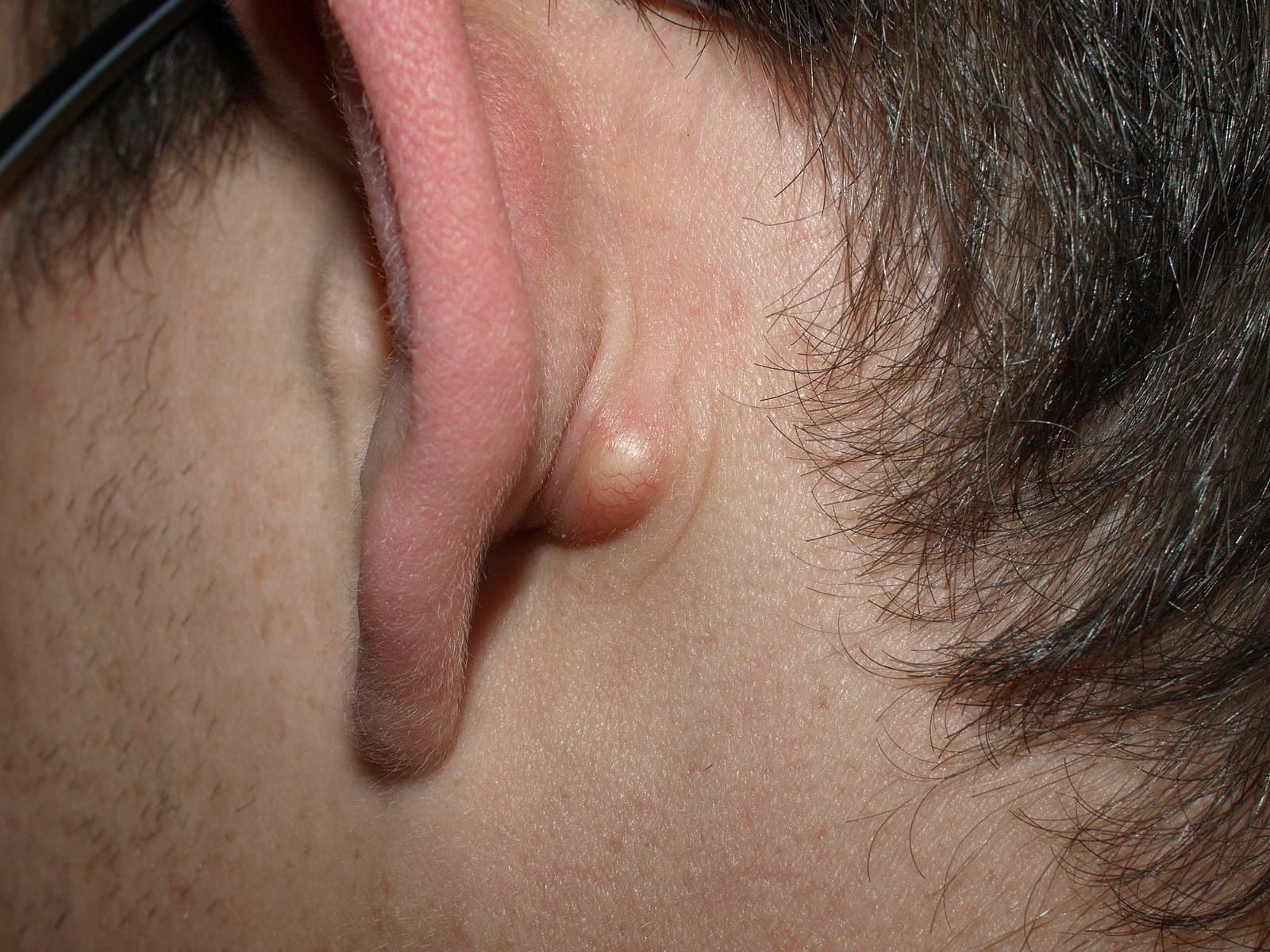 Close-up of a typical skin cyst behind the ear