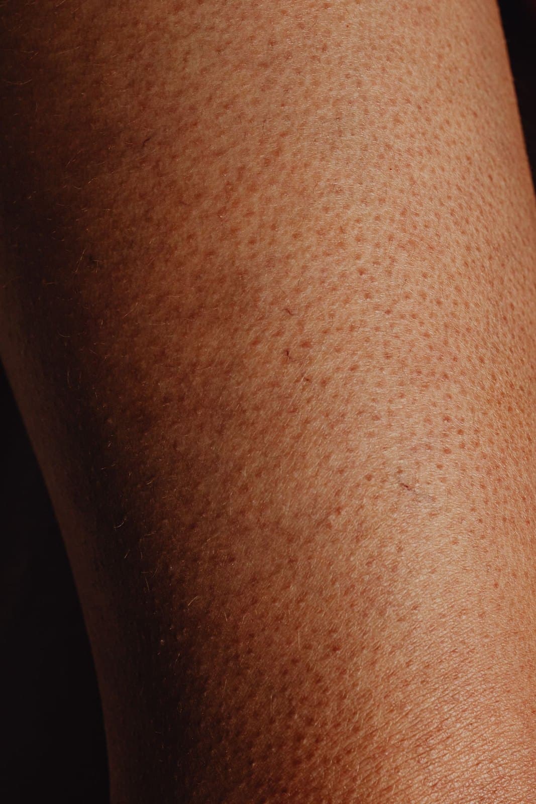 Close-up of a typical mole on skin